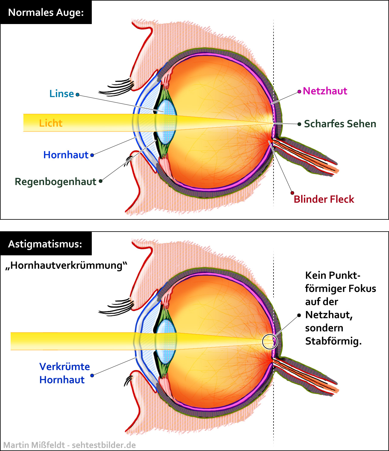 Was Ist Astigmatismus Hornhautverkrummung Augen